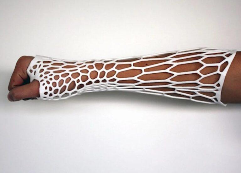 3D Printed Cast: A Game Changer for Orthopedic Care and Recovery